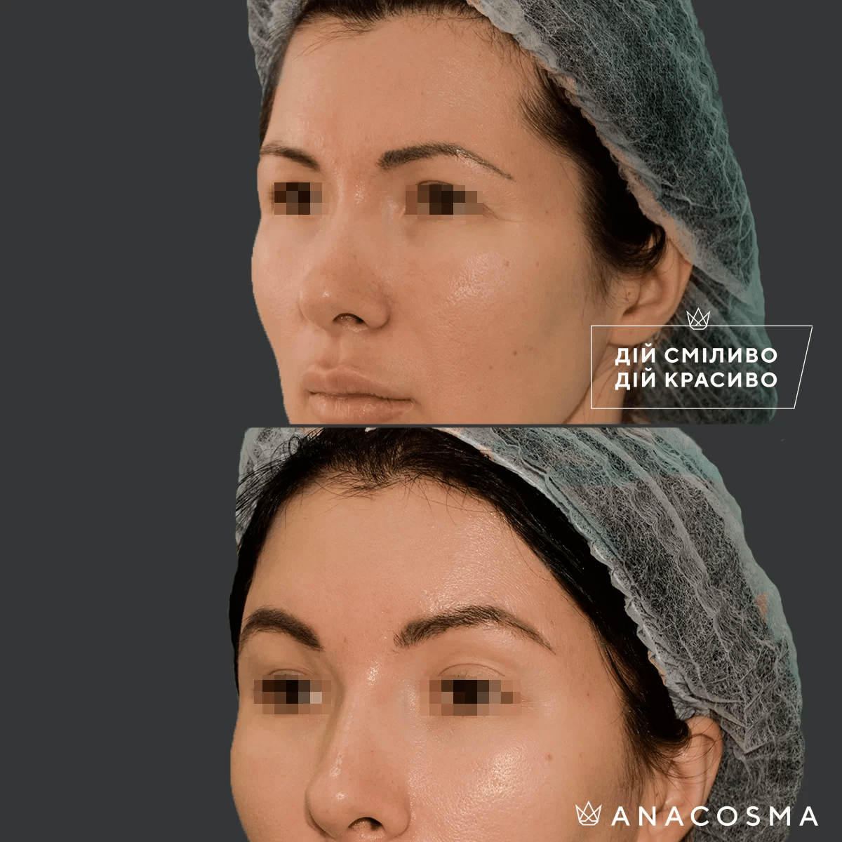 Підтяжка чола, ліфтинг брів до і після - Фото 1