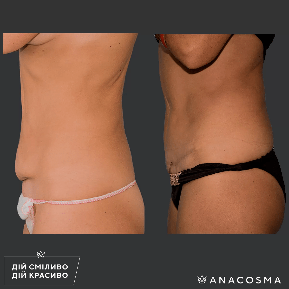 Абдомінопластика до і після - Фото 3