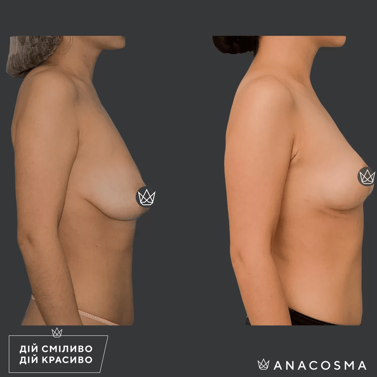 Підтяжка грудей (мастопексія) до і після - Фото 3
