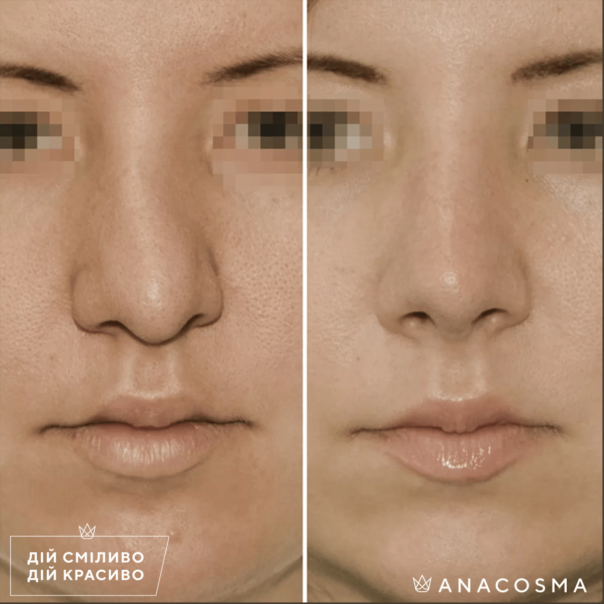 Септопластика (корекція перегородки носа) до і після - Фото 2