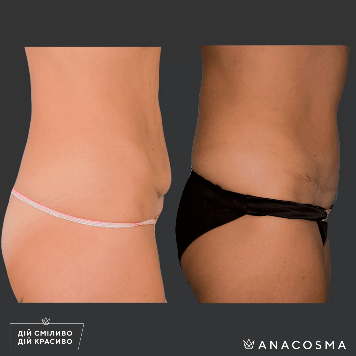 Абдомінопластика до і після - Фото 4