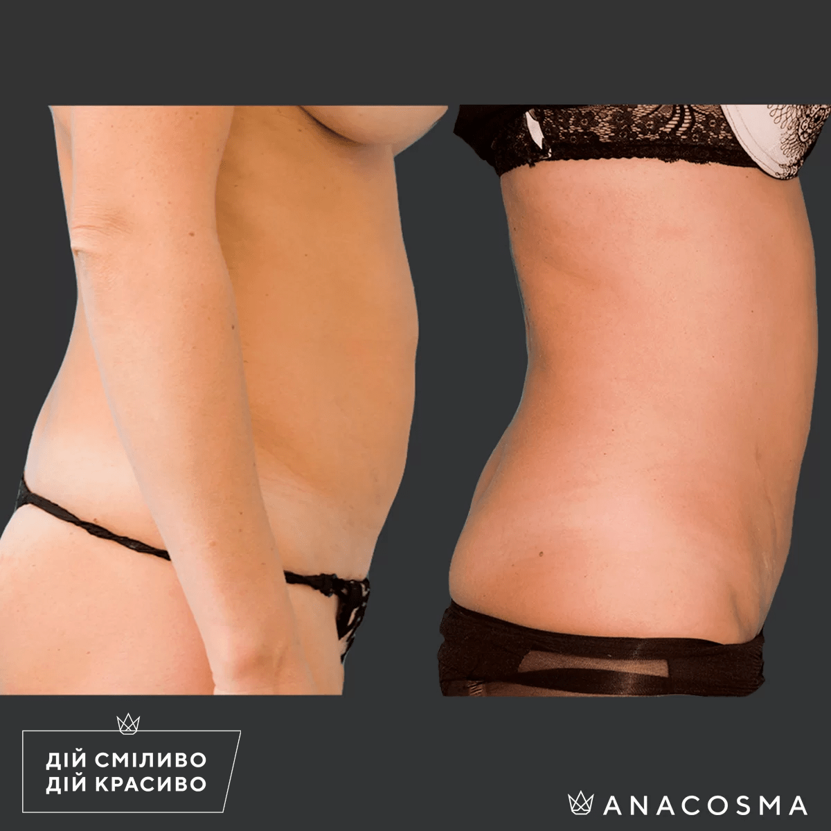 Абдомінопластика до і після - Фото 6