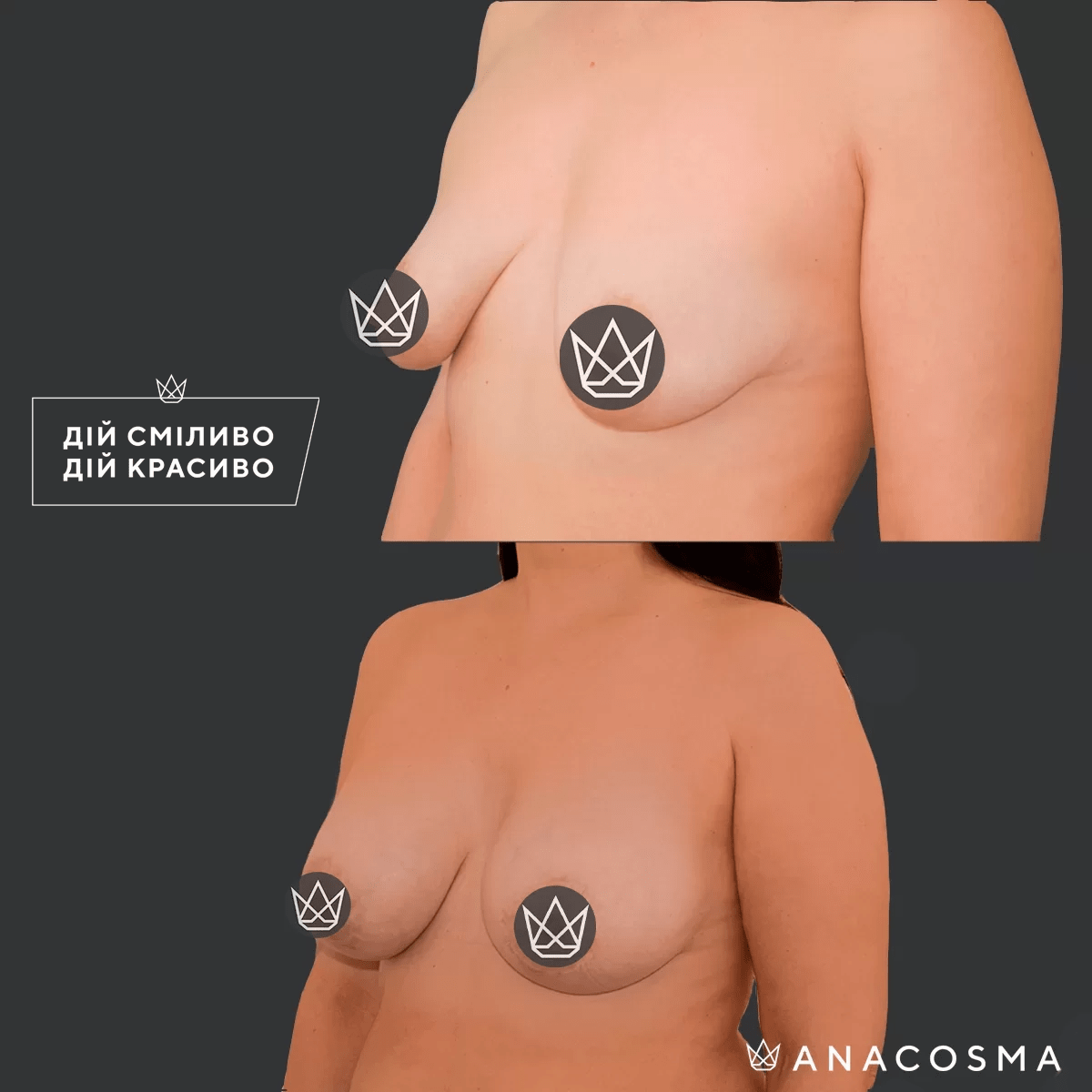 Підтяжка грудей (мастопексія) до і після - Фото 4