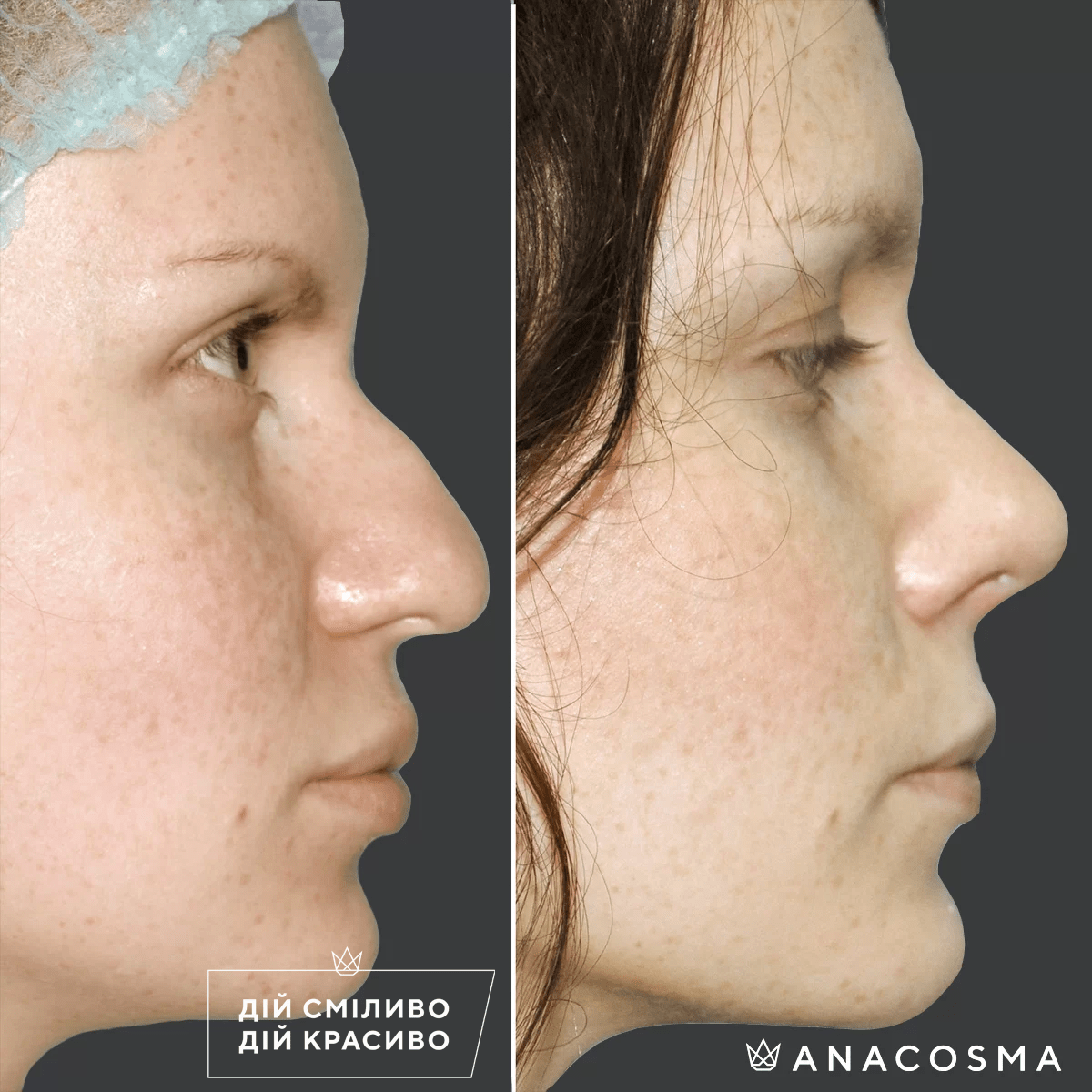 Септопластика (корекція перегородки носа) до і після - Фото 1