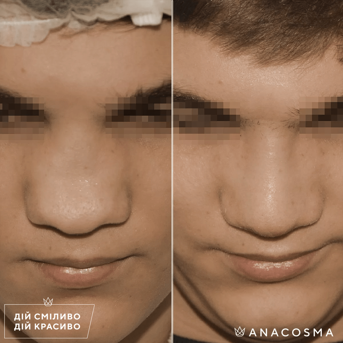 Септопластика (корекція перегородки носа) до і після - Фото 5