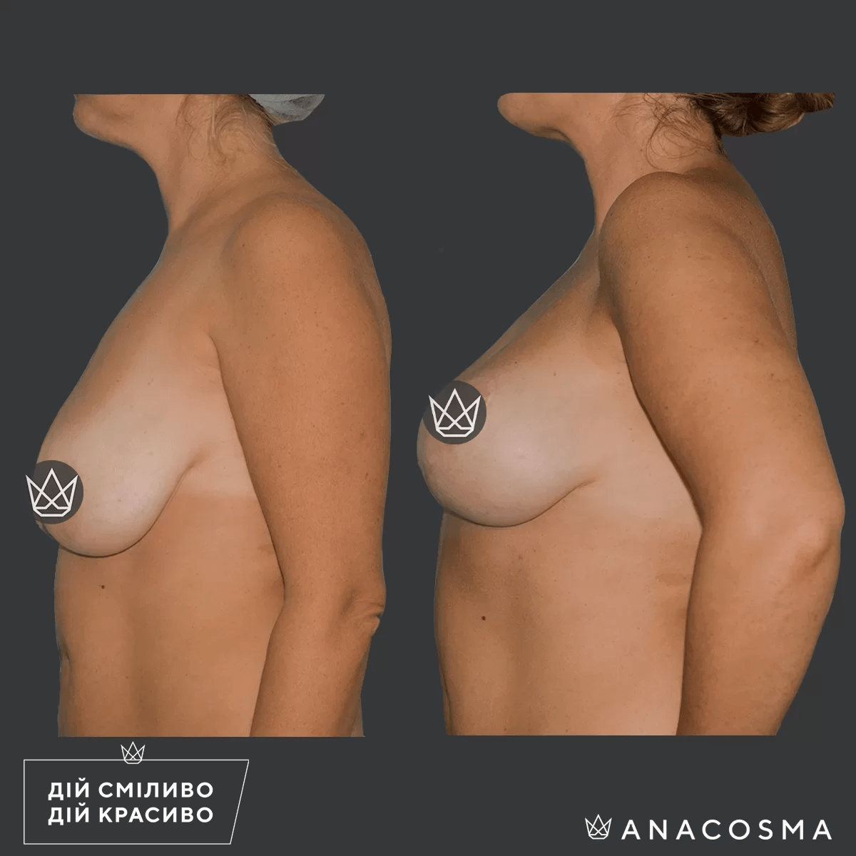 Підтяжка грудей (мастопексія) до і після - Фото 6