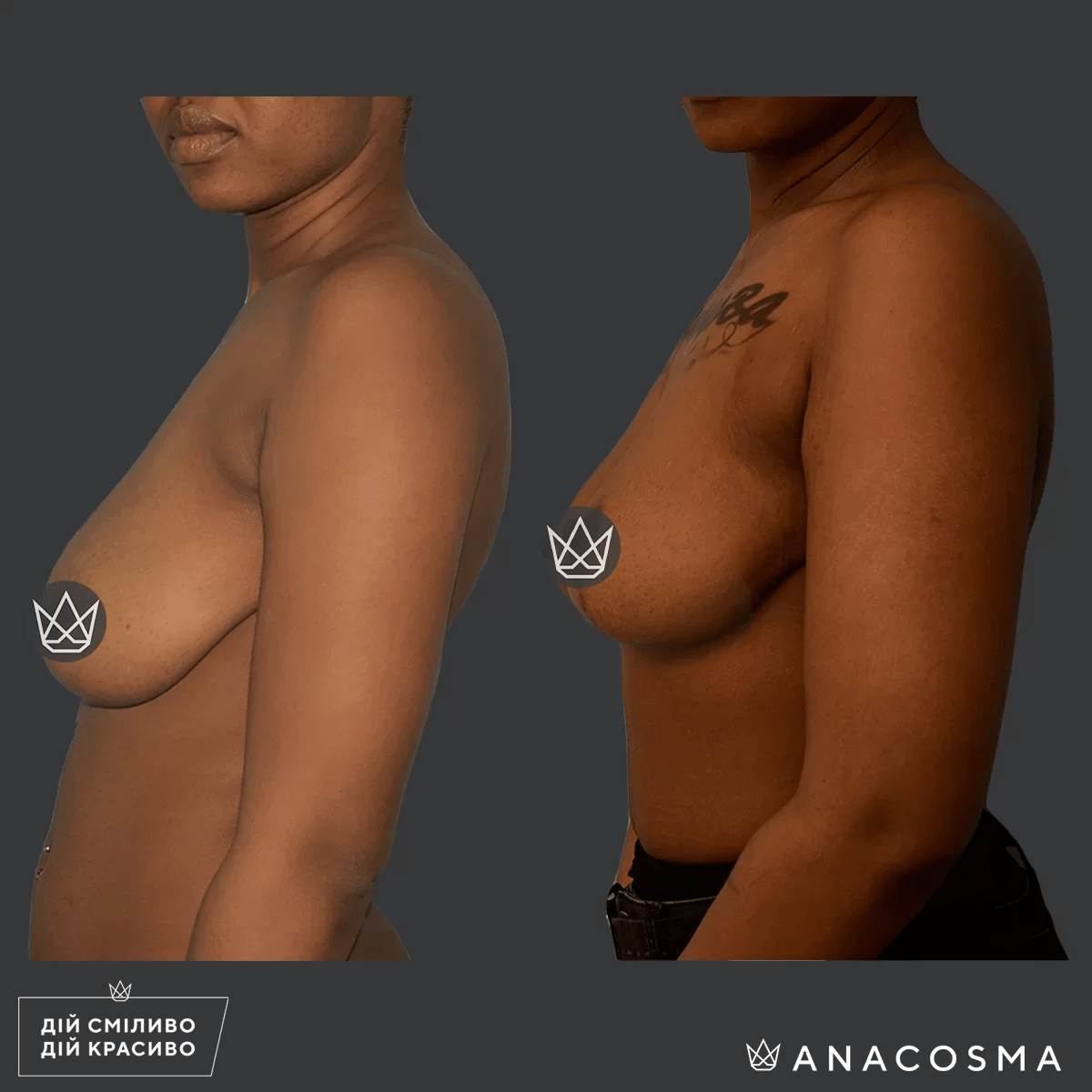 Підтяжка грудей (мастопексія) до і після - Фото 8