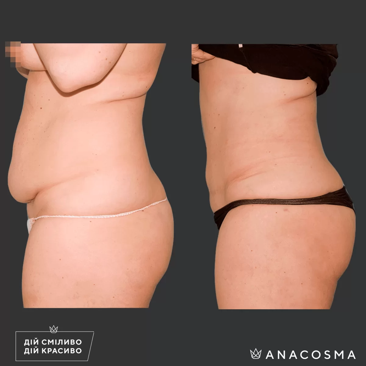 Абдомінопластика до і після - Фото 5
