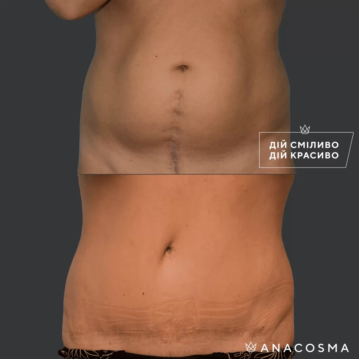 Абдомінопластика до і після - Фото 7