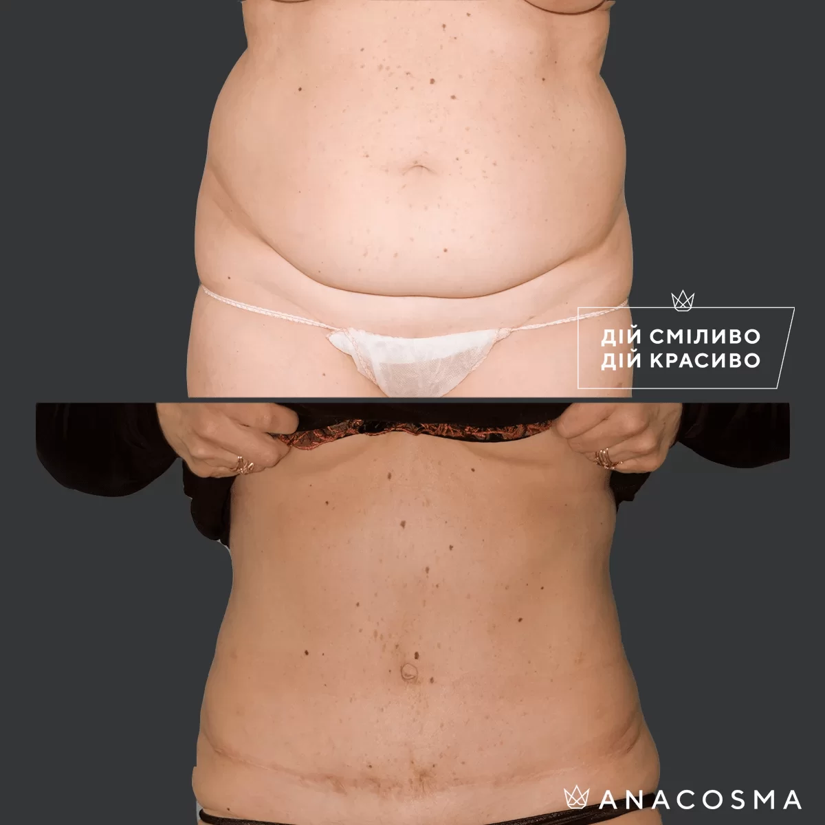 Абдомінопластика до і після - Фото 10