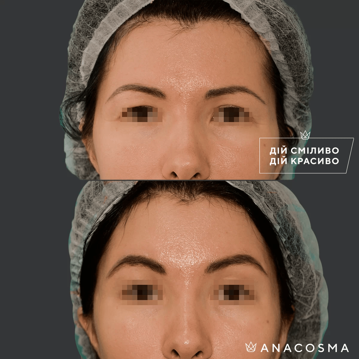 Підтяжка чола, ліфтинг брів до і після - Фото 2