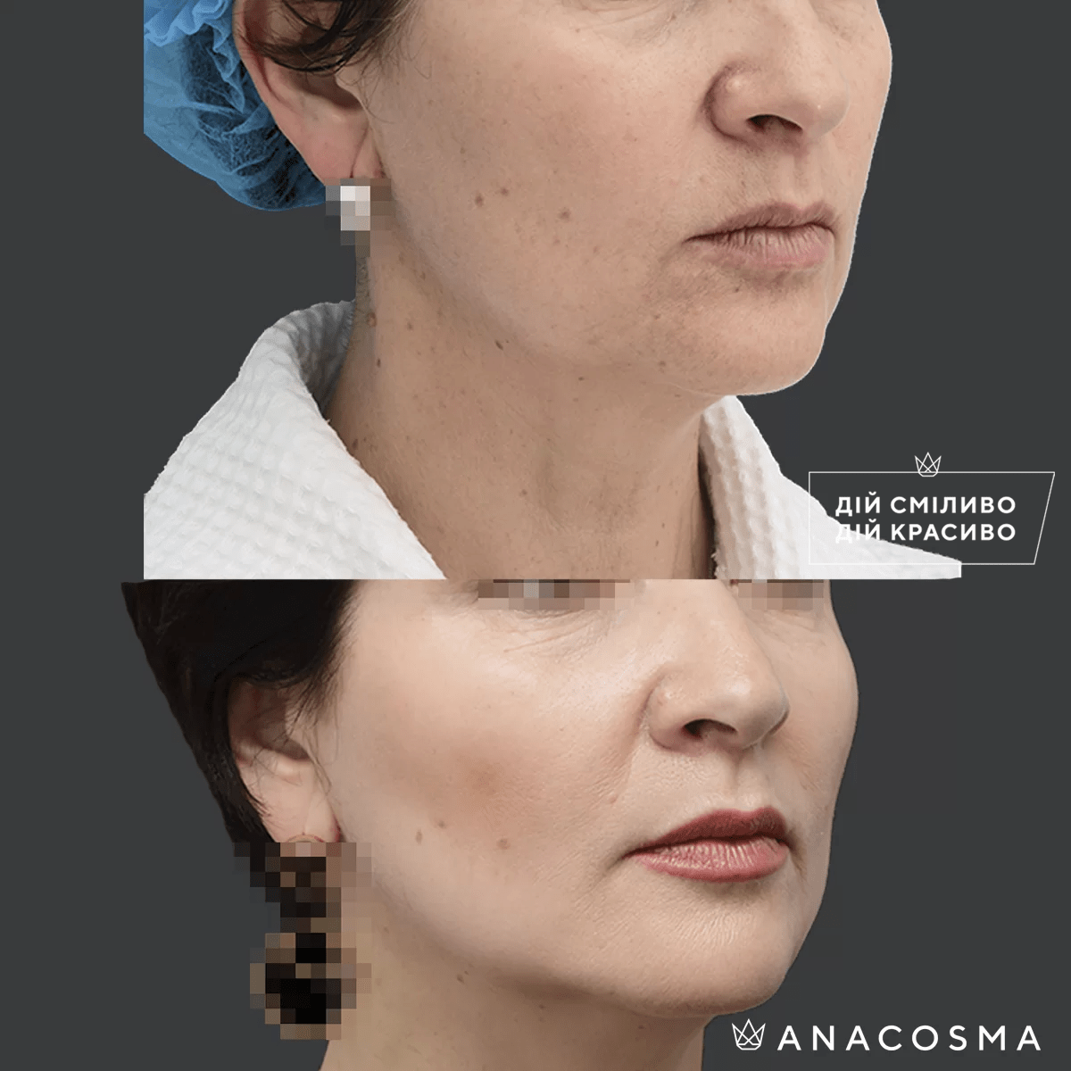 Контурна пластика обличчя (ін’єкції краси) до і після - Фото 1