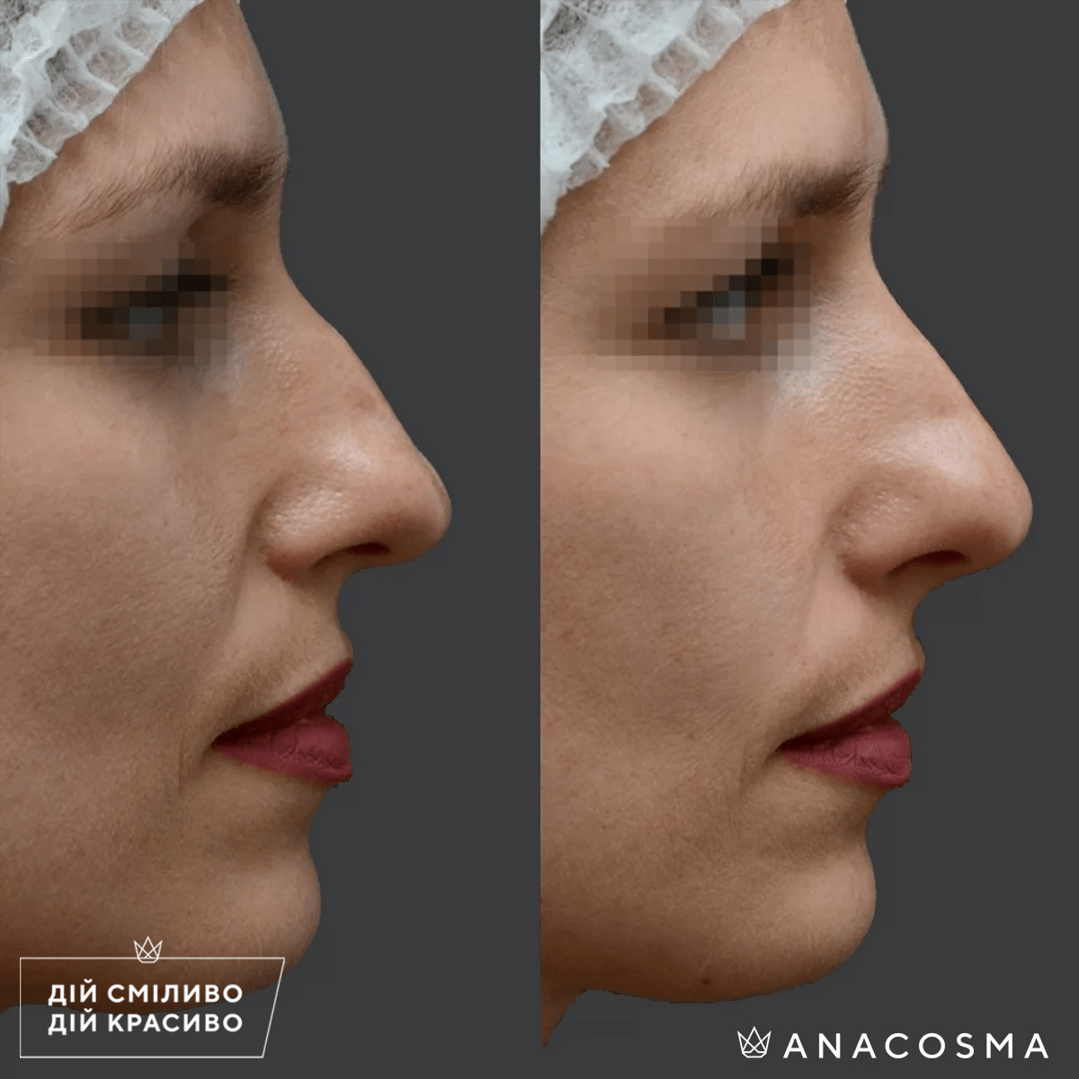 Безопераційна ринопластика до і після - Фото 1
