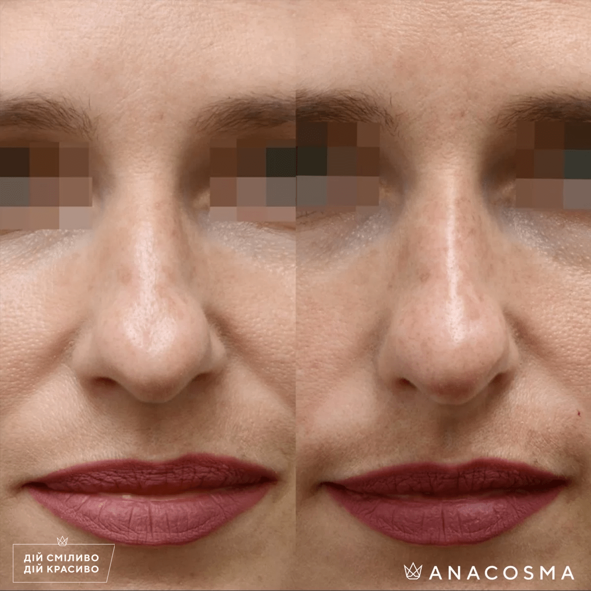 Безопераційна ринопластика до і після - Фото 2