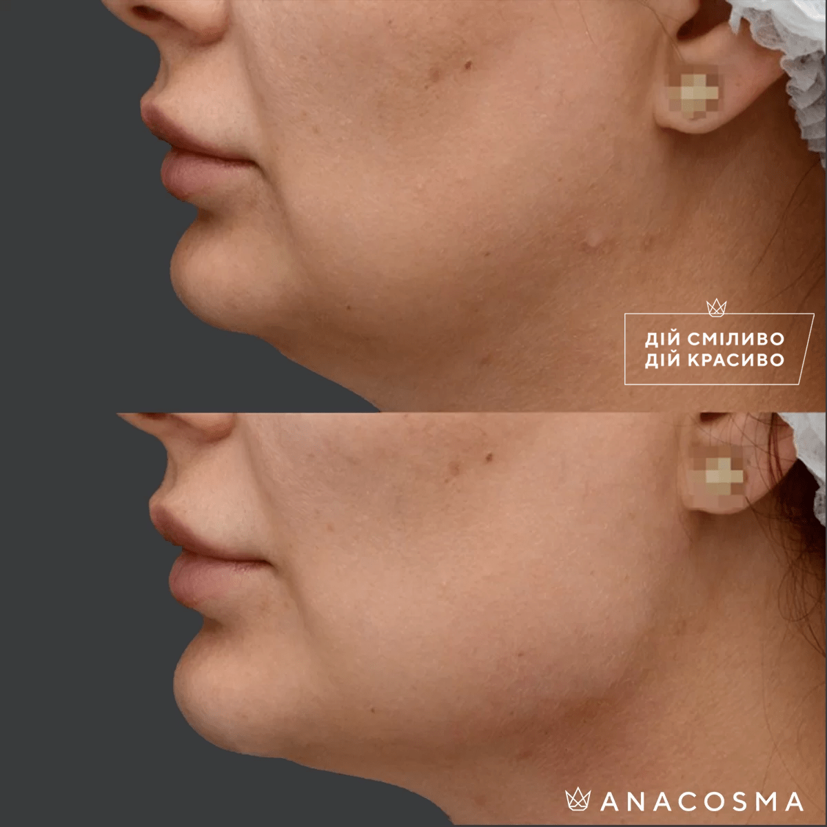 Контурна пластика обличчя (ін’єкції краси) до і після - Фото 4