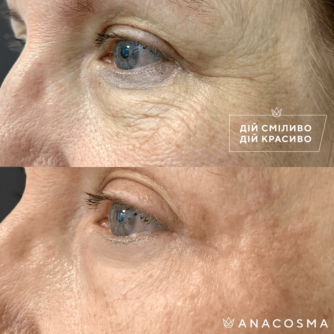 Бланшинг Belotero до і після - Фото 4