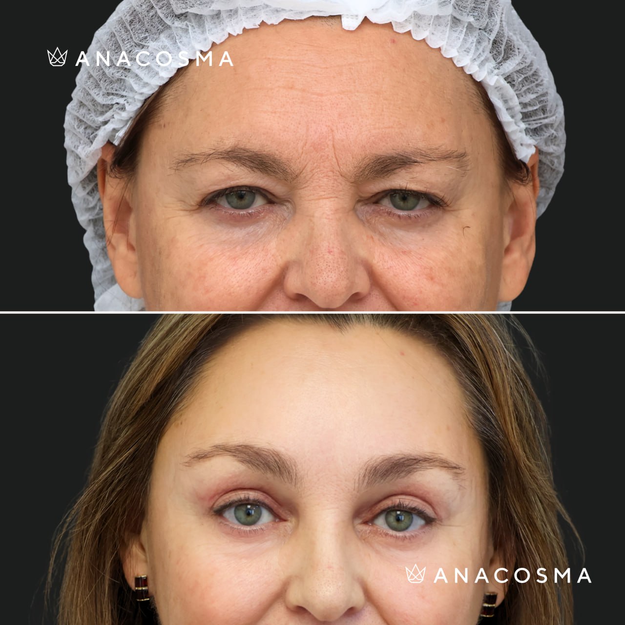 Blepharoplasty before and after - Photo 3