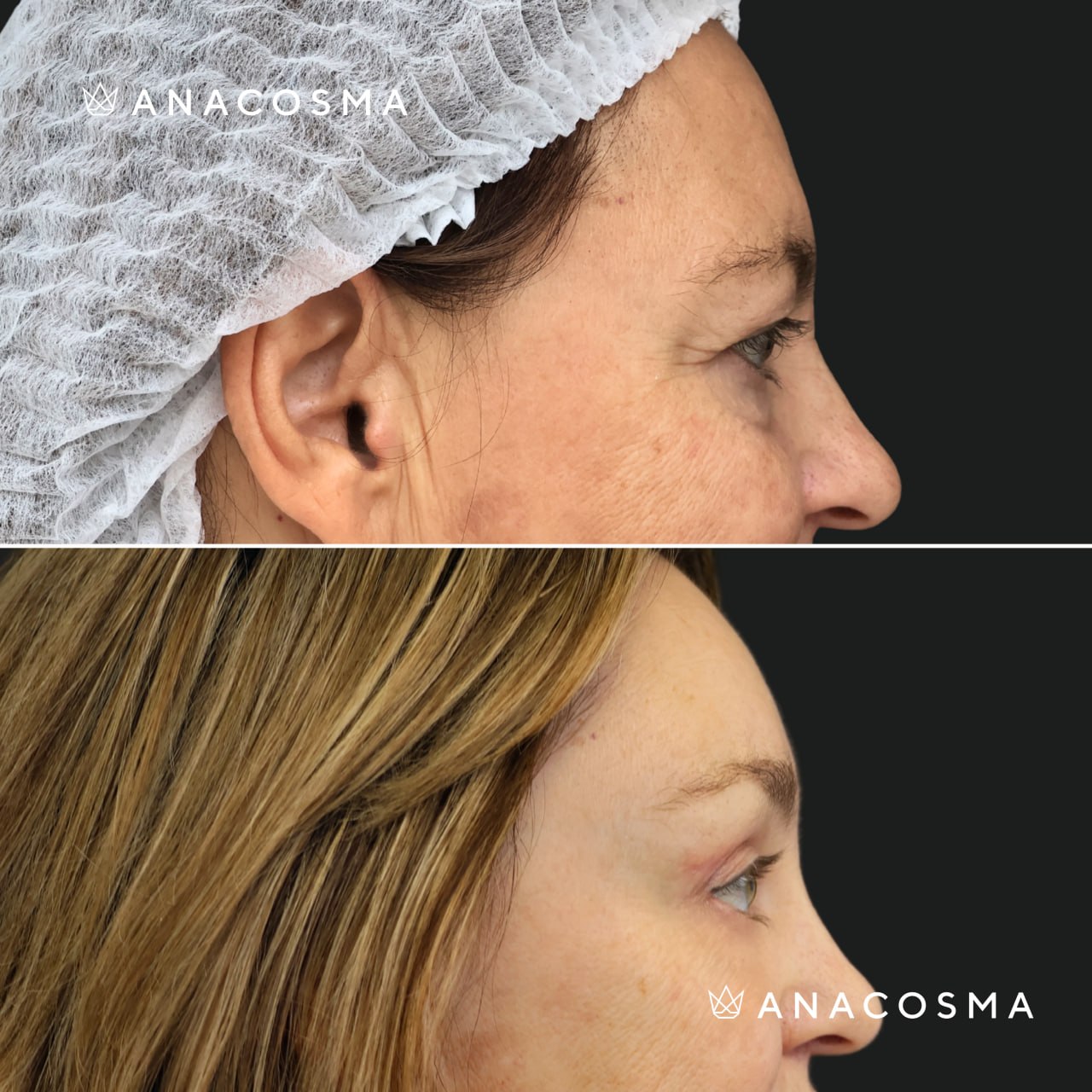 Blepharoplasty before and after - Photo 4