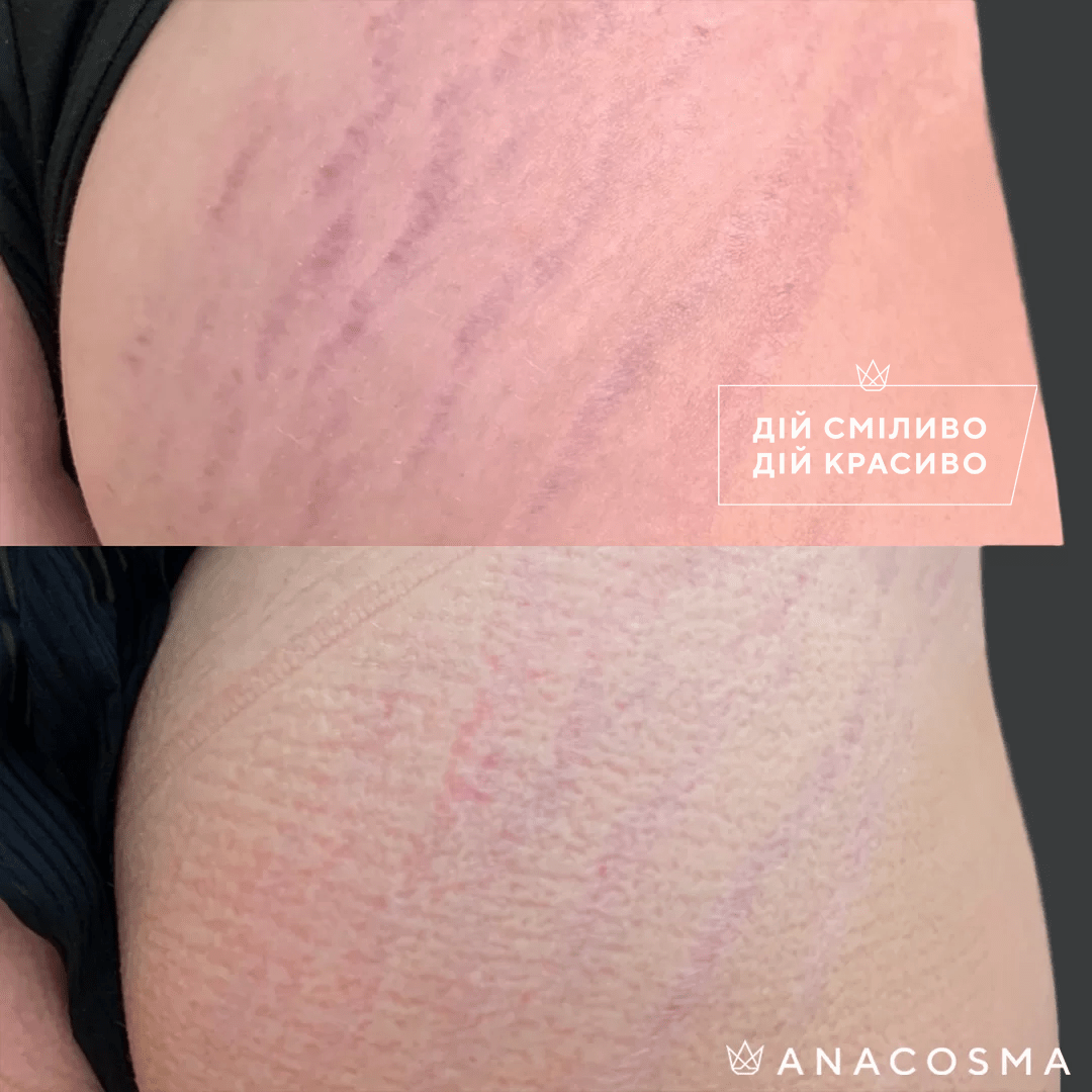 Ліполітики, Ферментотерапія до і після - Фото 1