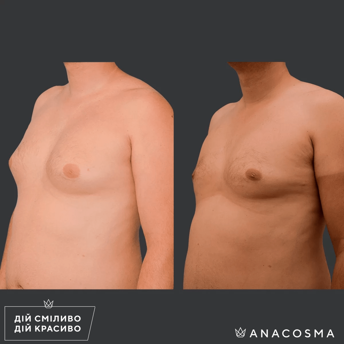 Гінекомастія до і після - Фото 1