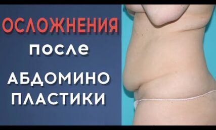 Які можуть бути ускладнення після абдомінопластики? Як їх уникнути?