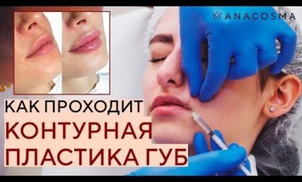 ЗБІЛЬШЕННЯ ГУБ 💋ДО і ПІСЛЯ 💉 ЯК ПРОХОДИТЬ ПРОЦЕДУРА?