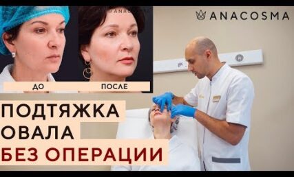 Підтяжка овалу БЕЗ ОПЕРАЦІЇ 💉 Фейсліфтінг філлером
