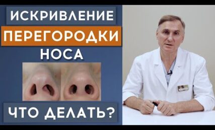ВИКРИВЛЕННЯ ПЕРЕГОРОДКИ НОСА ❗️ ЯК ПОЛІПШИТИ ДИХАННЯ? ❗️