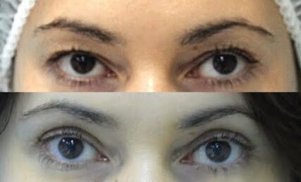 В якому випадку рекомендована підтяжка лоба, а в якому - блефаропластика?