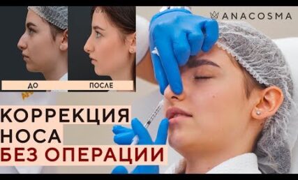 Як проводиться безопераційна ринопластика?