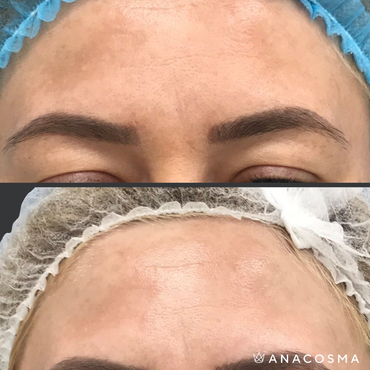 Видалення пігментних плям Cutera LimeLight до і після - Фото 2