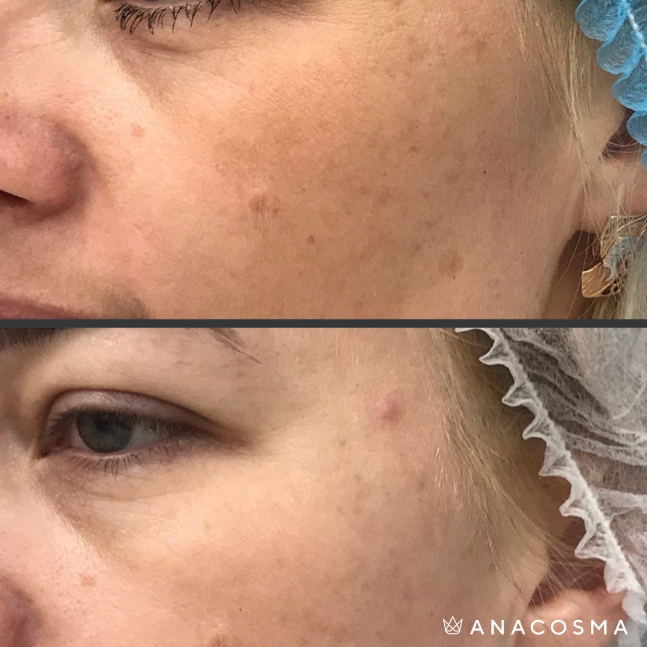 Видалення пігментних плям Cutera LimeLight до і після - Фото 3