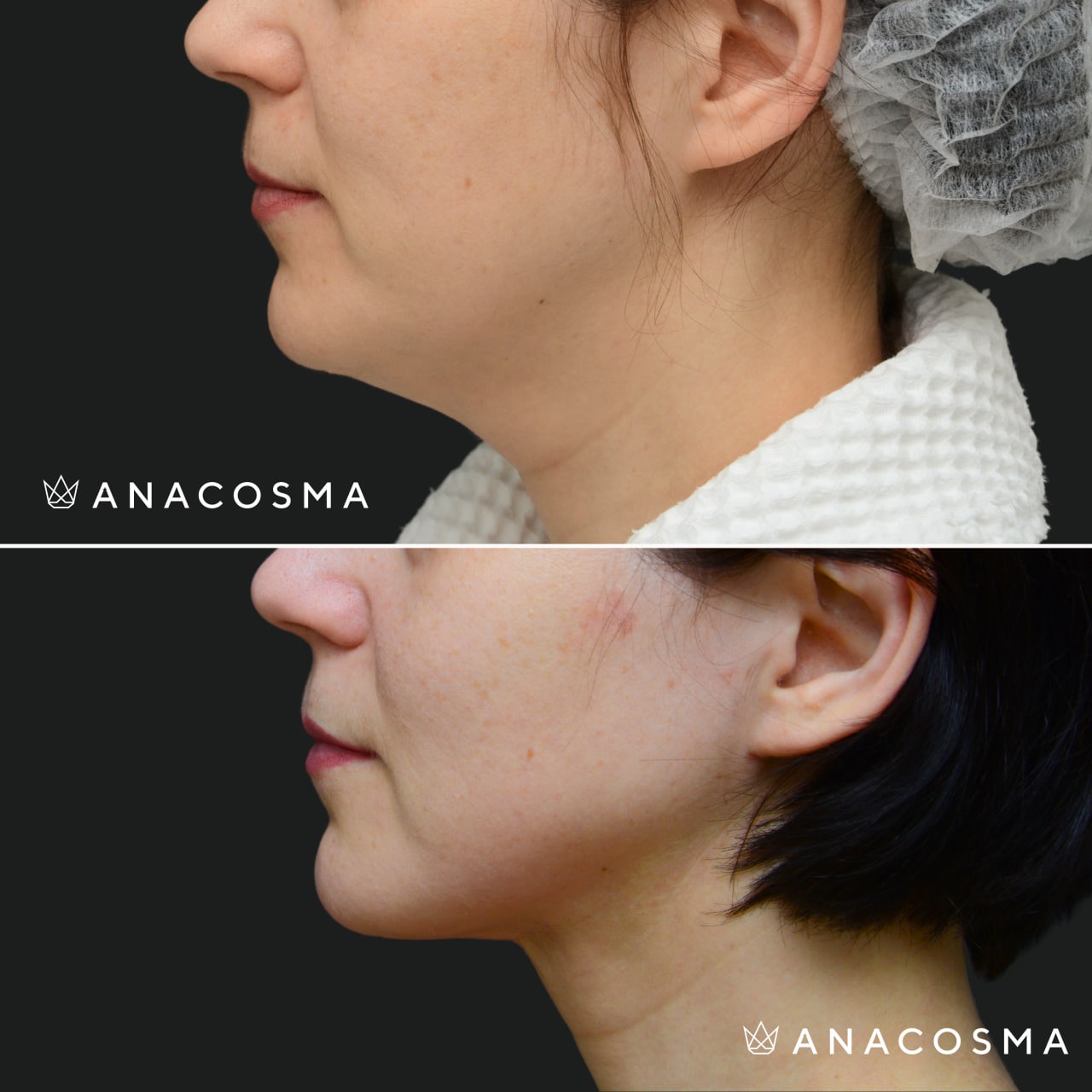 V-овал: чіткий кут молодості до і після - Фото 13