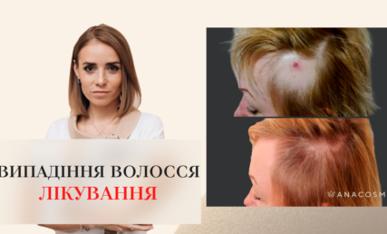 ЧОМУ ВИПАДАЄ ВОЛОССЯ І ЯК ЦЕ ВИЛІКУВАТИ?