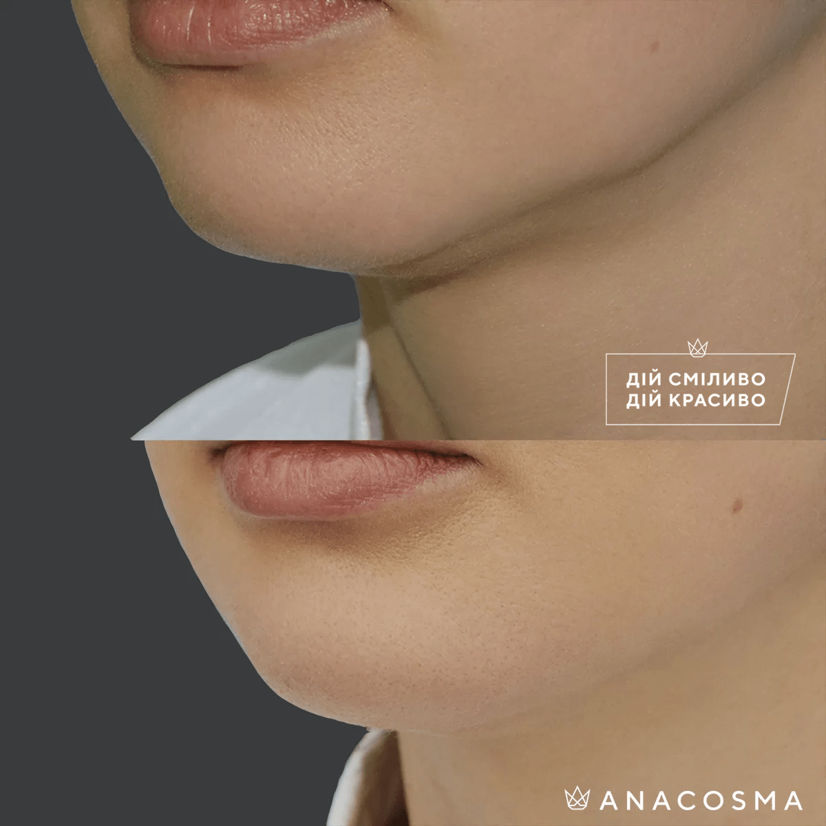 Контурна пластика обличчя (ін’єкції краси) до і після - Фото 9