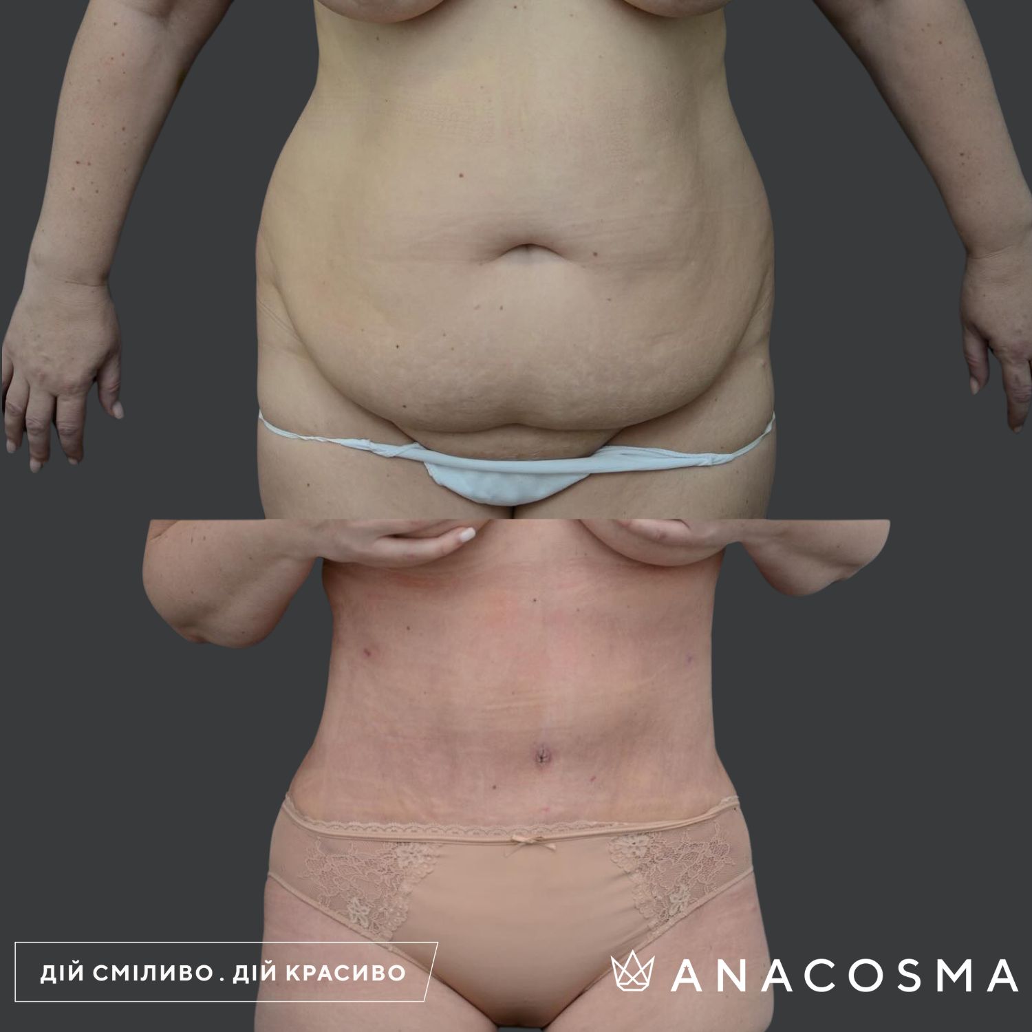 Абдомінопластика до і після - Фото 2