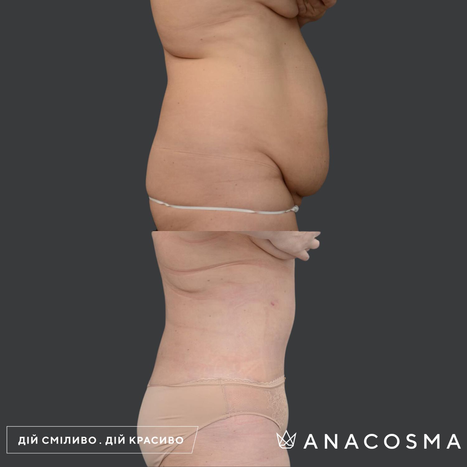 Абдомінопластика до і після - Фото 1