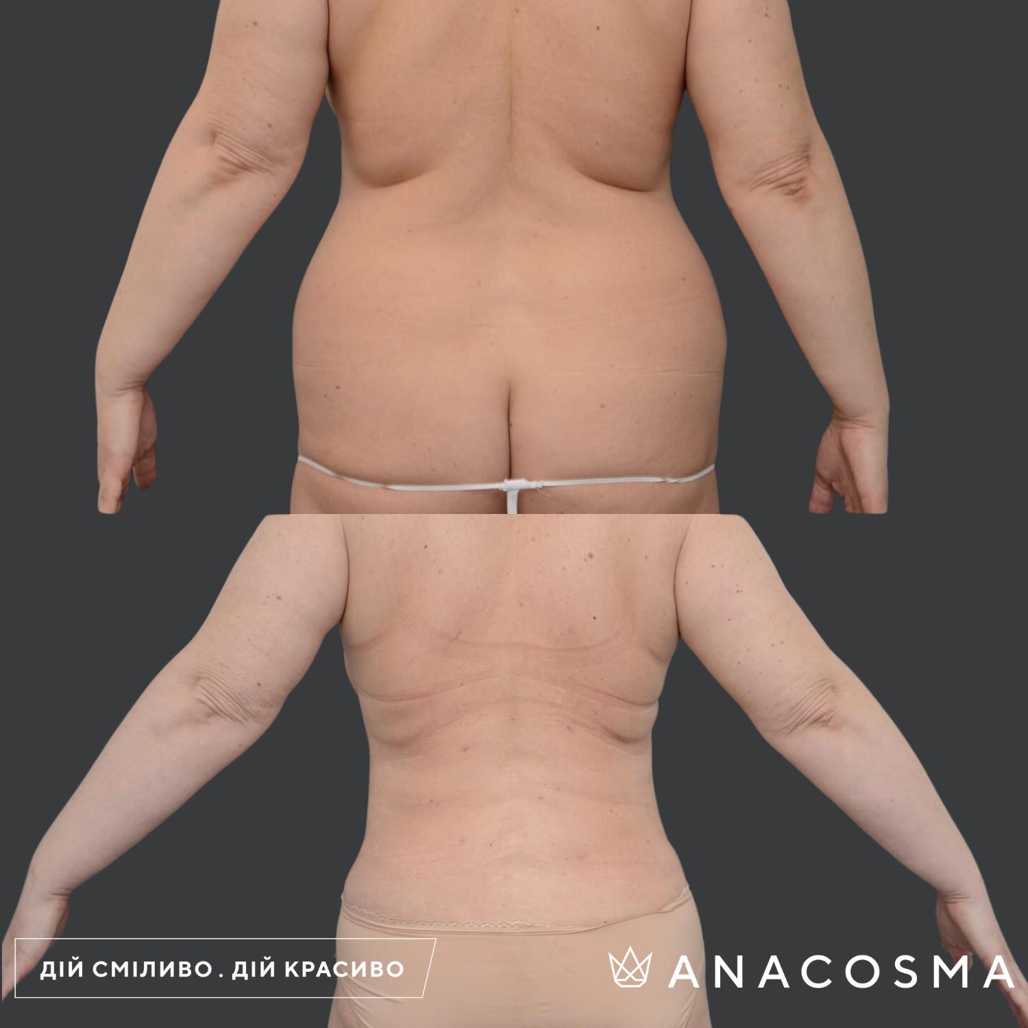 Абдомінопластика до і після - Фото 12