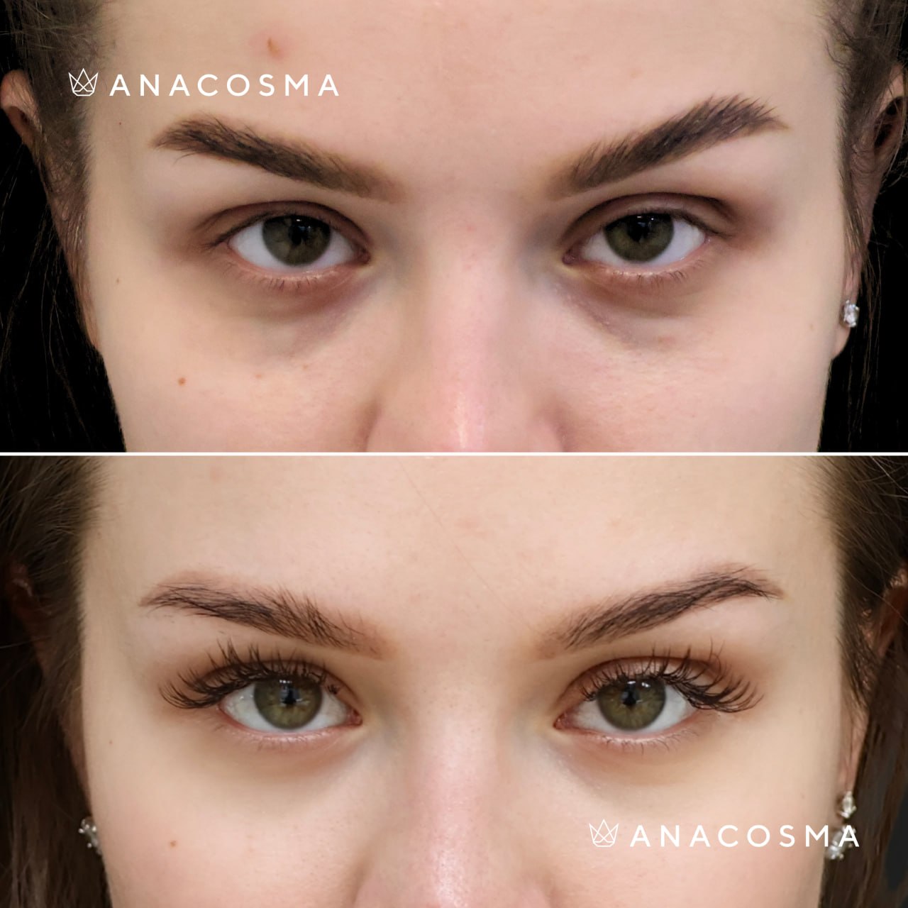 Blepharoplasty before and after - Photo 5