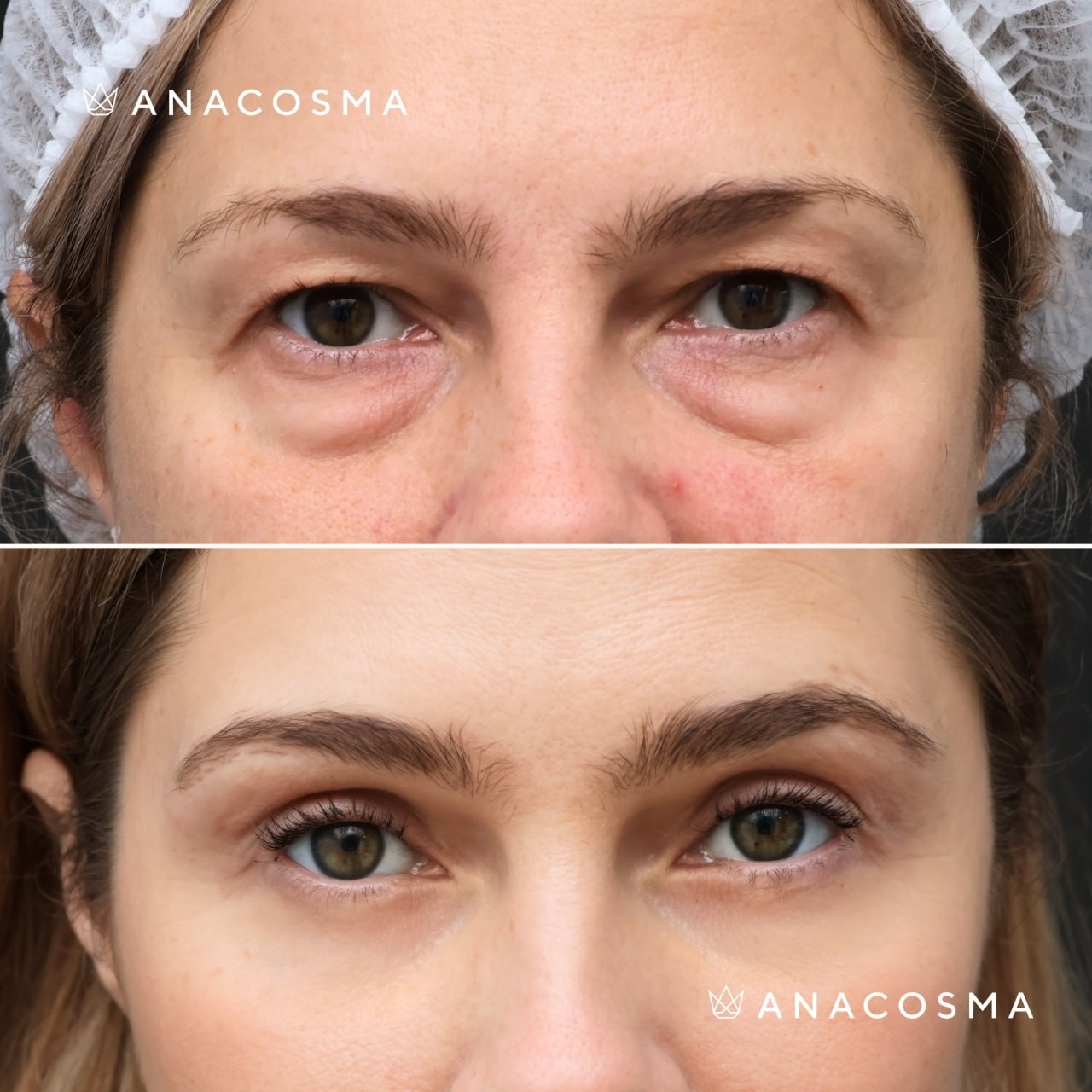 Blepharoplasty before and after - Photo 1