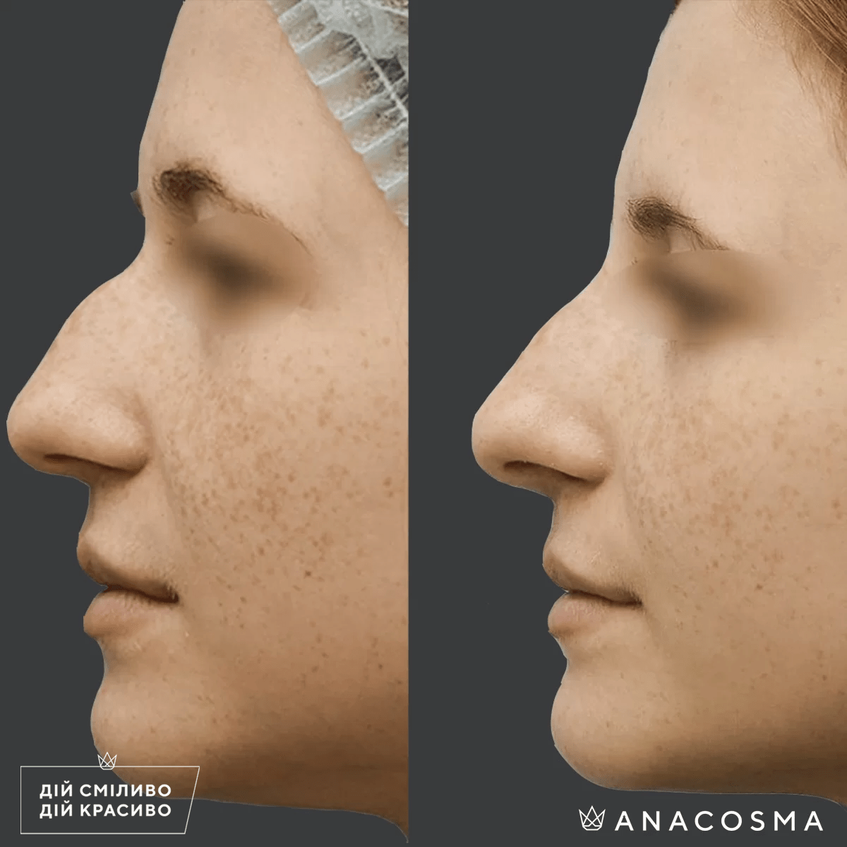 Безопераційна ринопластика до і після - Фото 5