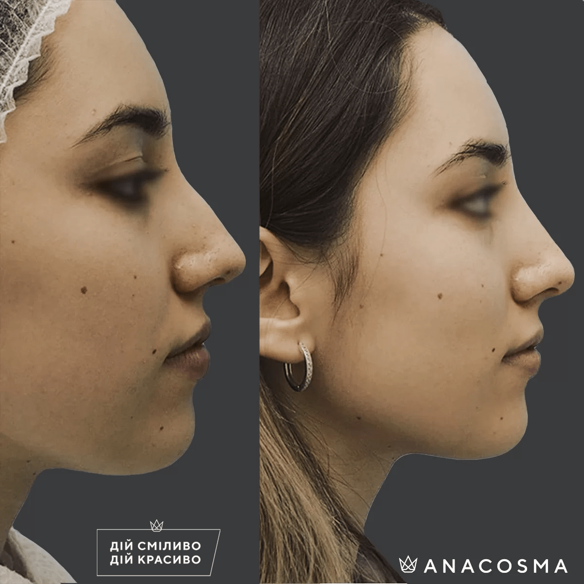 Безопераційна ринопластика до і після - Фото 6