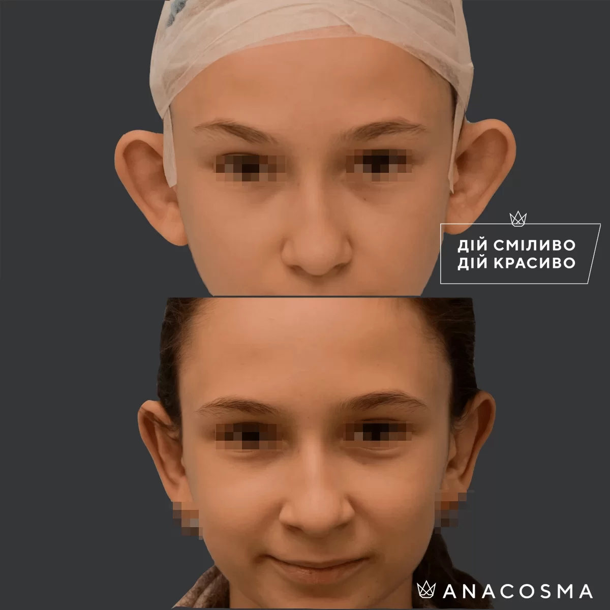 Отопластика (Пластика вух) до і після - Фото 2