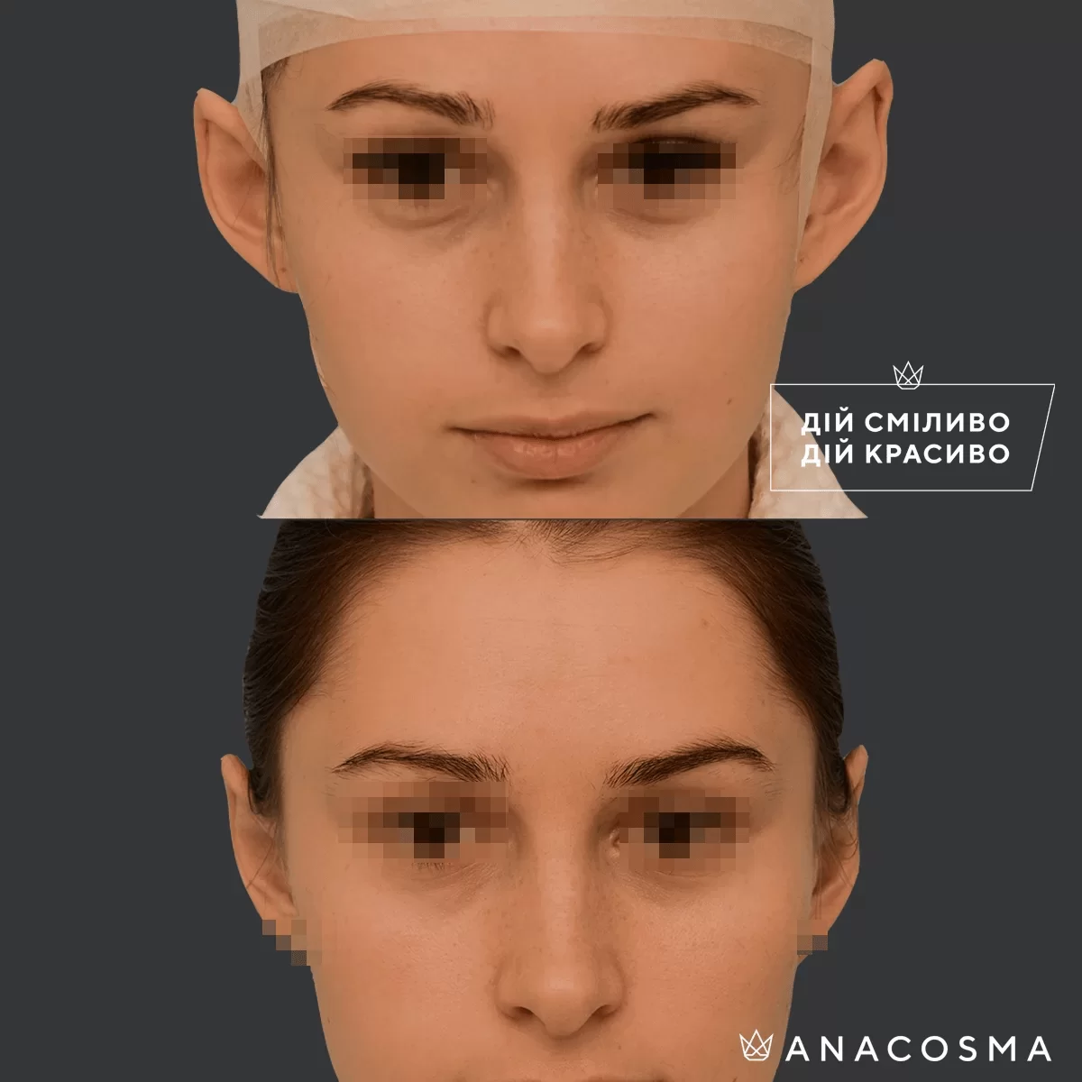 Отопластика (Пластика вух) до і після - Фото 3