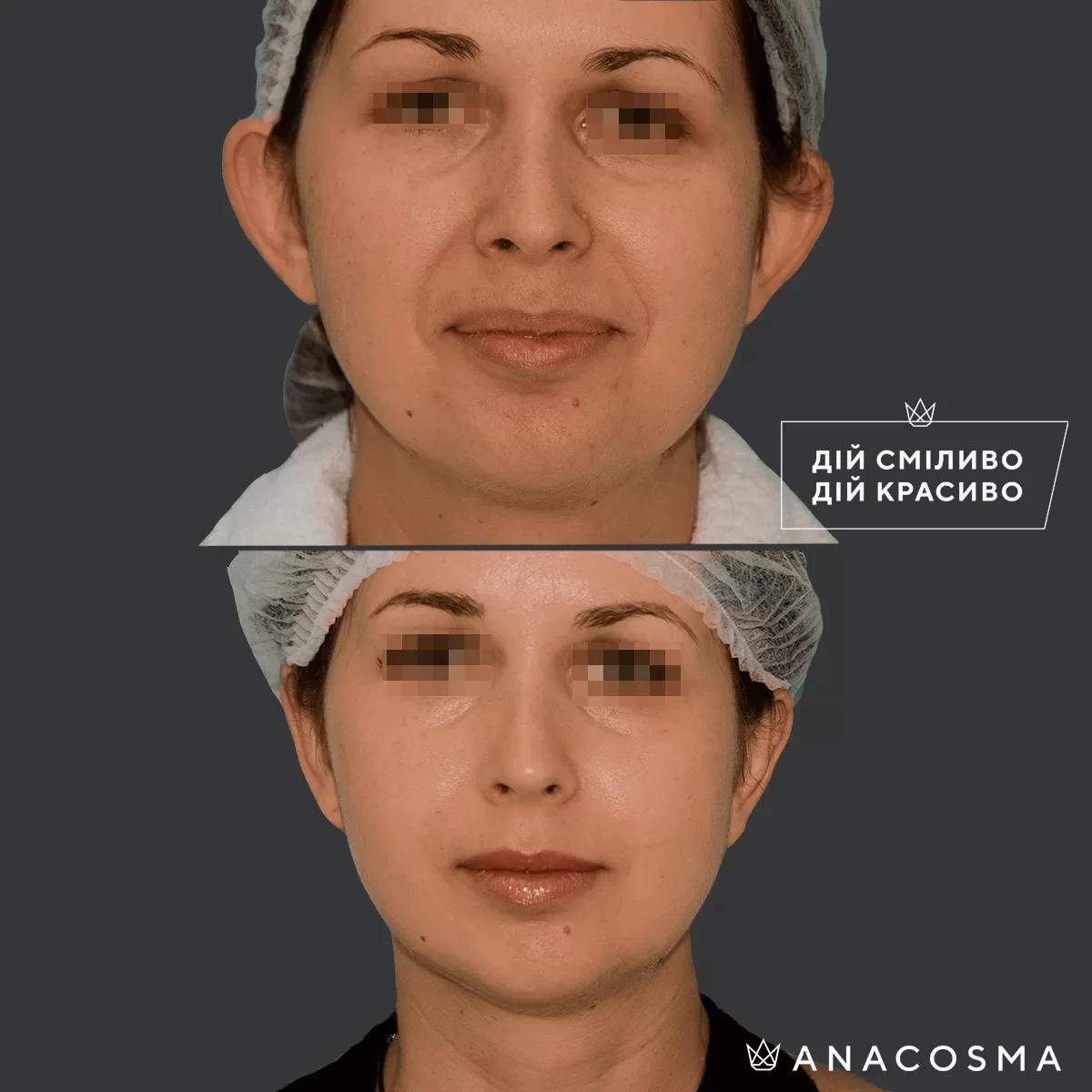 Отопластика (Пластика вух) до і після - Фото 5