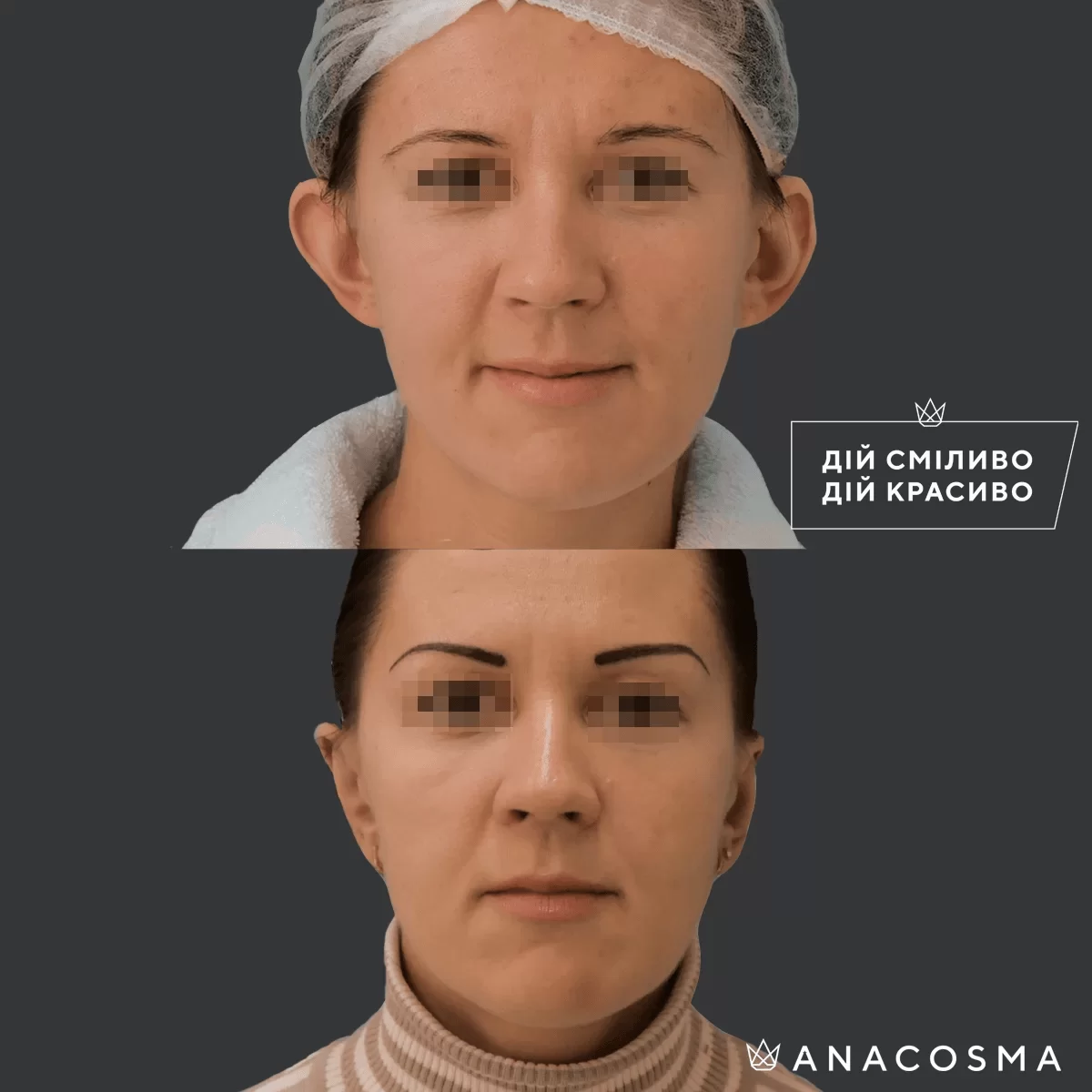 Отопластика (Пластика вух) до і після - Фото 8