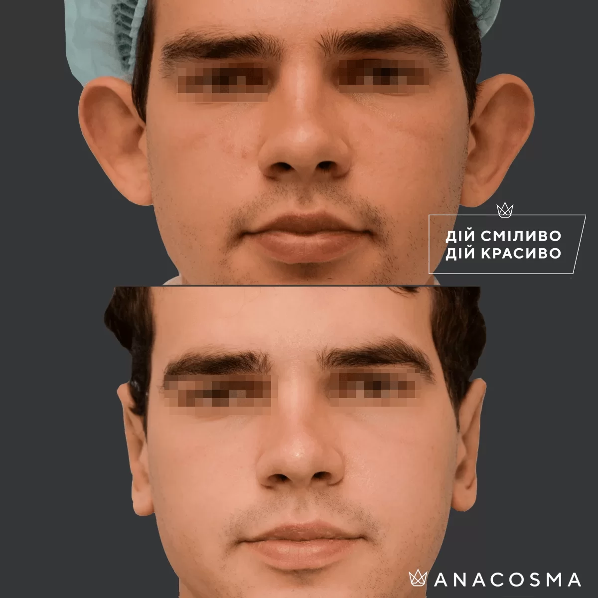 Отопластика (Пластика вух) до і після - Фото 9