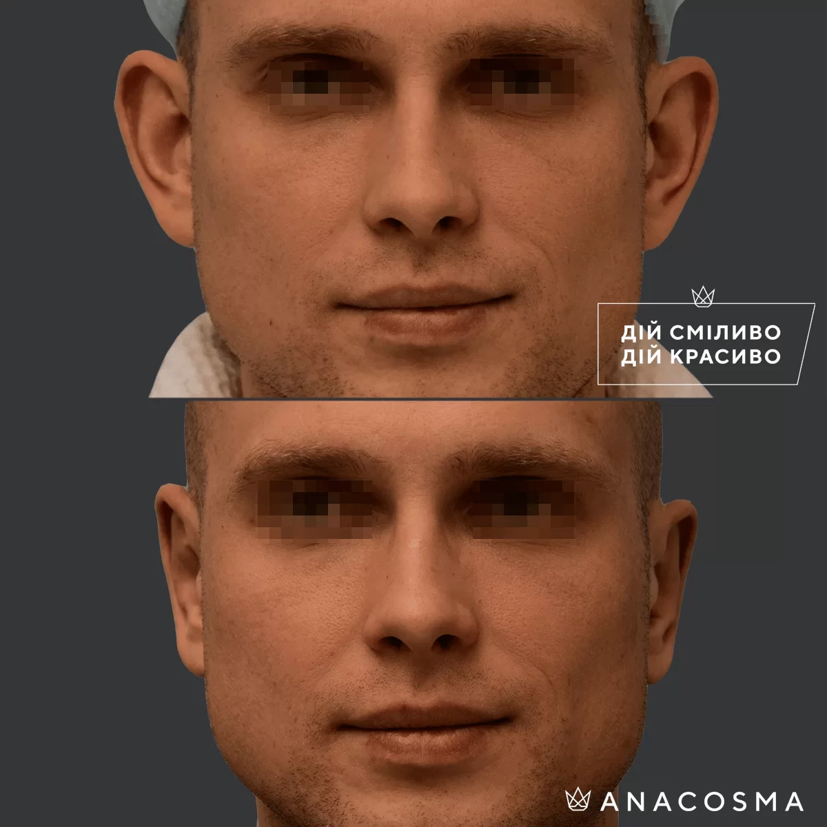 Отопластика (Пластика вух) до і після - Фото 1