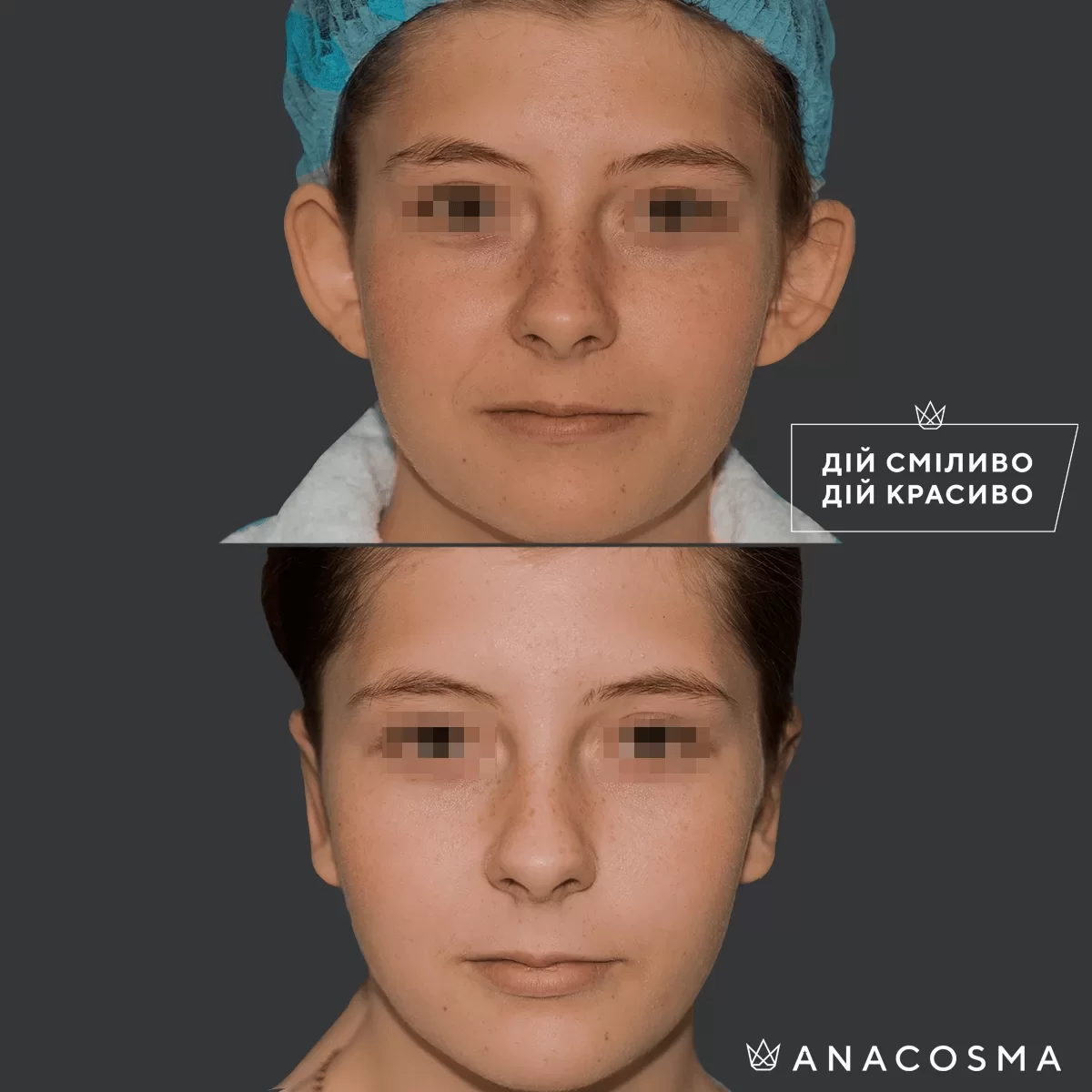 Отопластика (Пластика вух) до і після - Фото 7