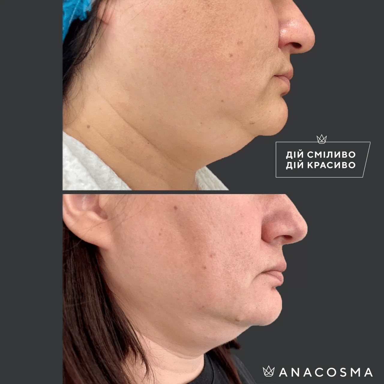 Ліполітики, Ферментотерапія до і після - Фото 2